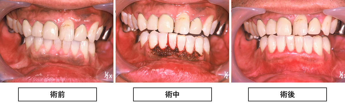 レーザー治療実例